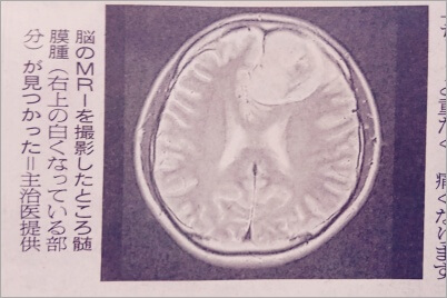 安田章大 脳腫瘍の画像